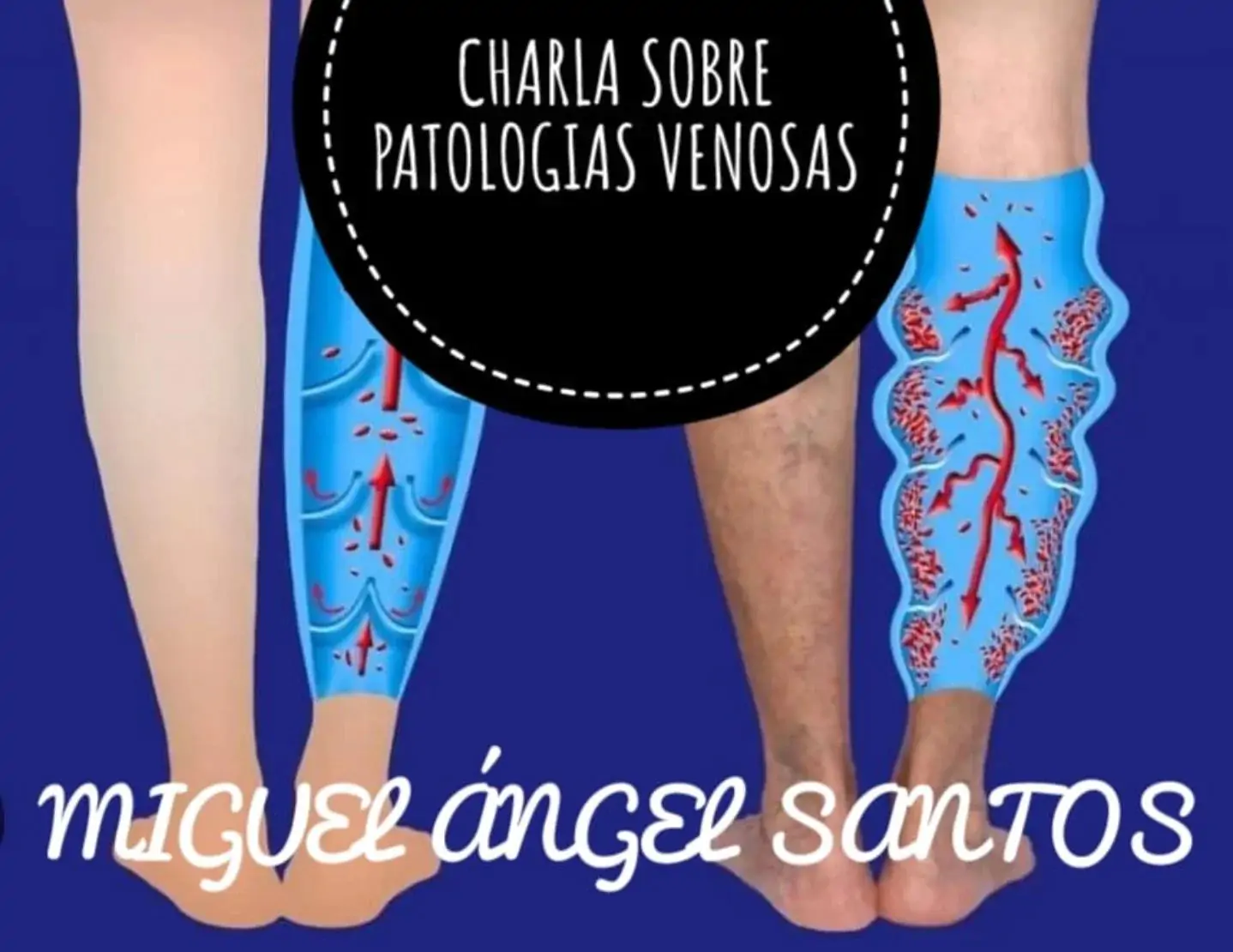 Charla sobre patologías venosas | enBenas.com